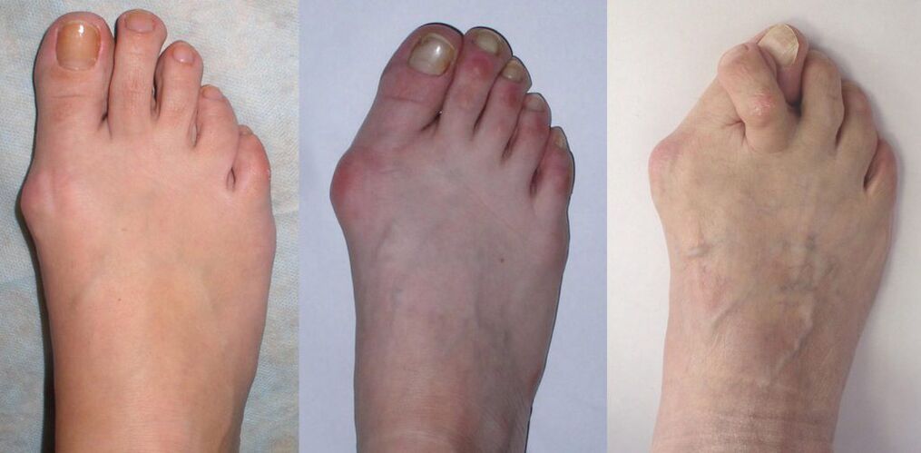 Artritis del pie