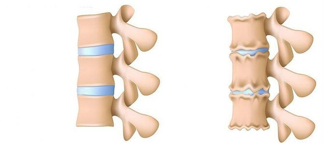 ¿Qué es la osteocondrosis