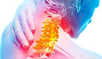 Signos de osteocondrosis de la columna cervical
