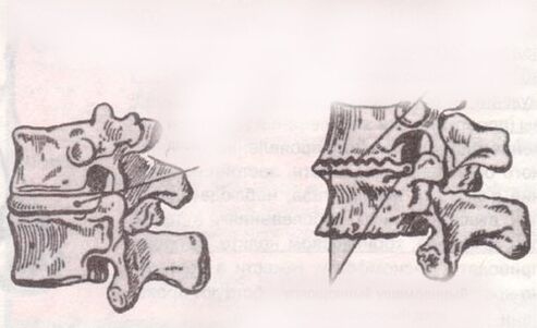El disco intervertebral es sano y con osteocondrosis lumbar