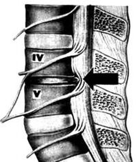 X -Ray Imagen del Departamento de Osteocondrosis Lumbar