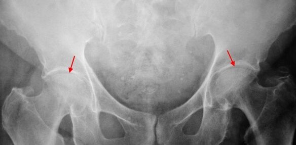 COKSARTROSIS DOBLE COKSARTROSIS de la brecha articular, esclerosis de las superficies articulares