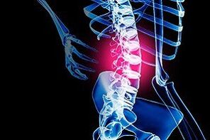osteocondrosis de la columna lumbar