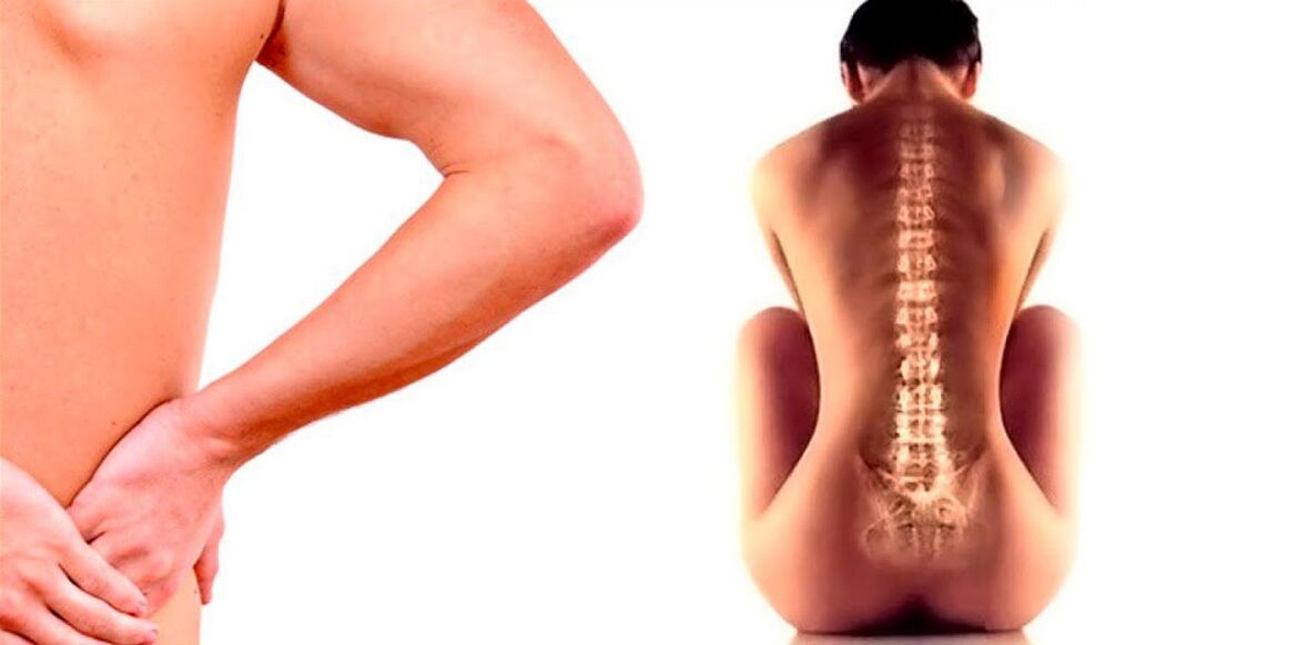 dolor lumbar debido a la osteocondrosis