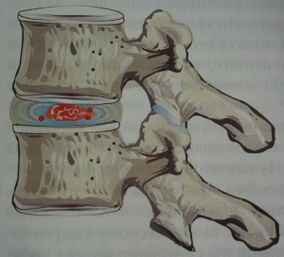 Primera etapa de la osteocondrosis.