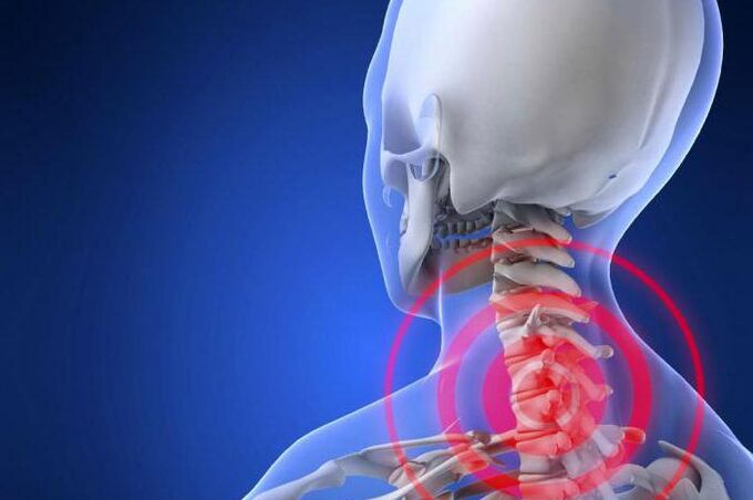 El dolor punzante en el cuello es un síntoma temprano de la osteocondrosis cervical