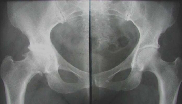 radiografía de la articulación de la cadera afectada con artrosis